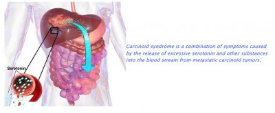 Carcinoid Syndrome diagram