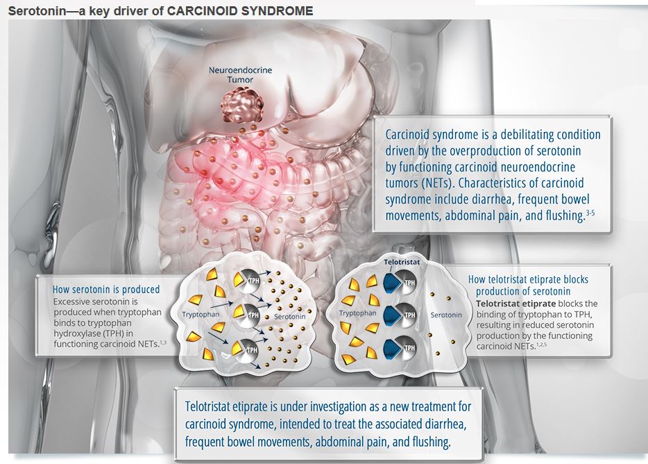 Serotonin as a key driver in carcinoid syndrome