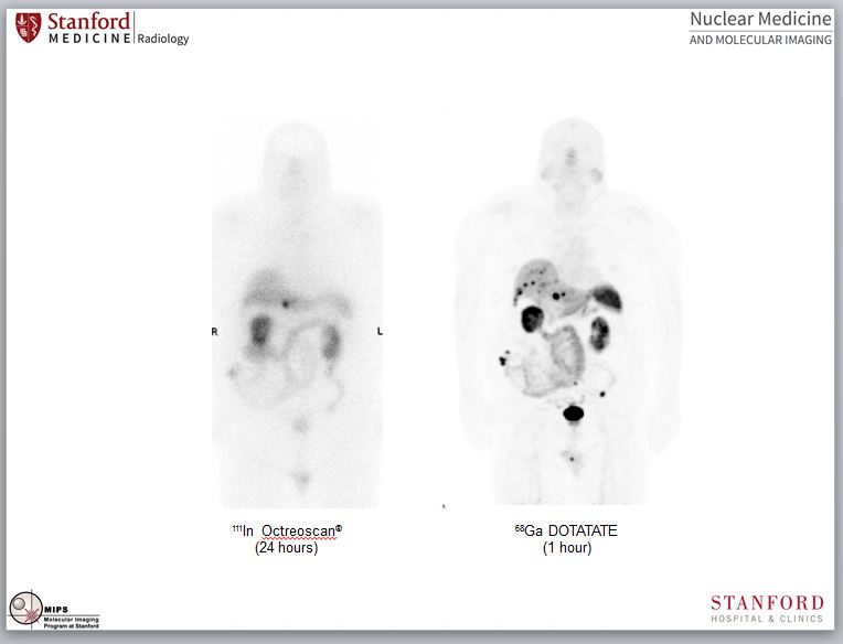 Patient scanned with Gallium-68 DOTATATE PET/CT scan and Octreoscan