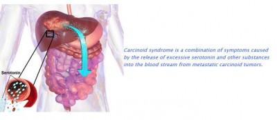 Carcinoid Syndrome Lexicon Pharmaceuticals Telotristat Etiprate Clinical Trial