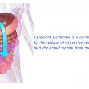 carcinoid syndrome lexicon pharmaceuticals telotristat etiprate clinical trial