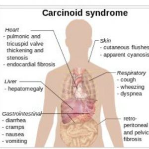 Carcinoid Syndrome presentation of symptoms diagram Wikipedia 2