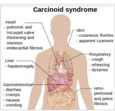 Carcinoid syndrome