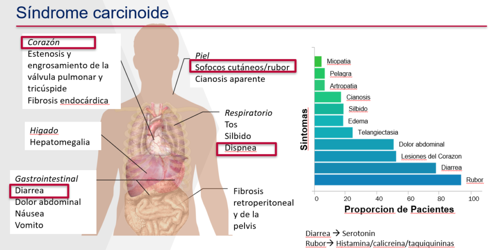 Sindrome Carcinoide